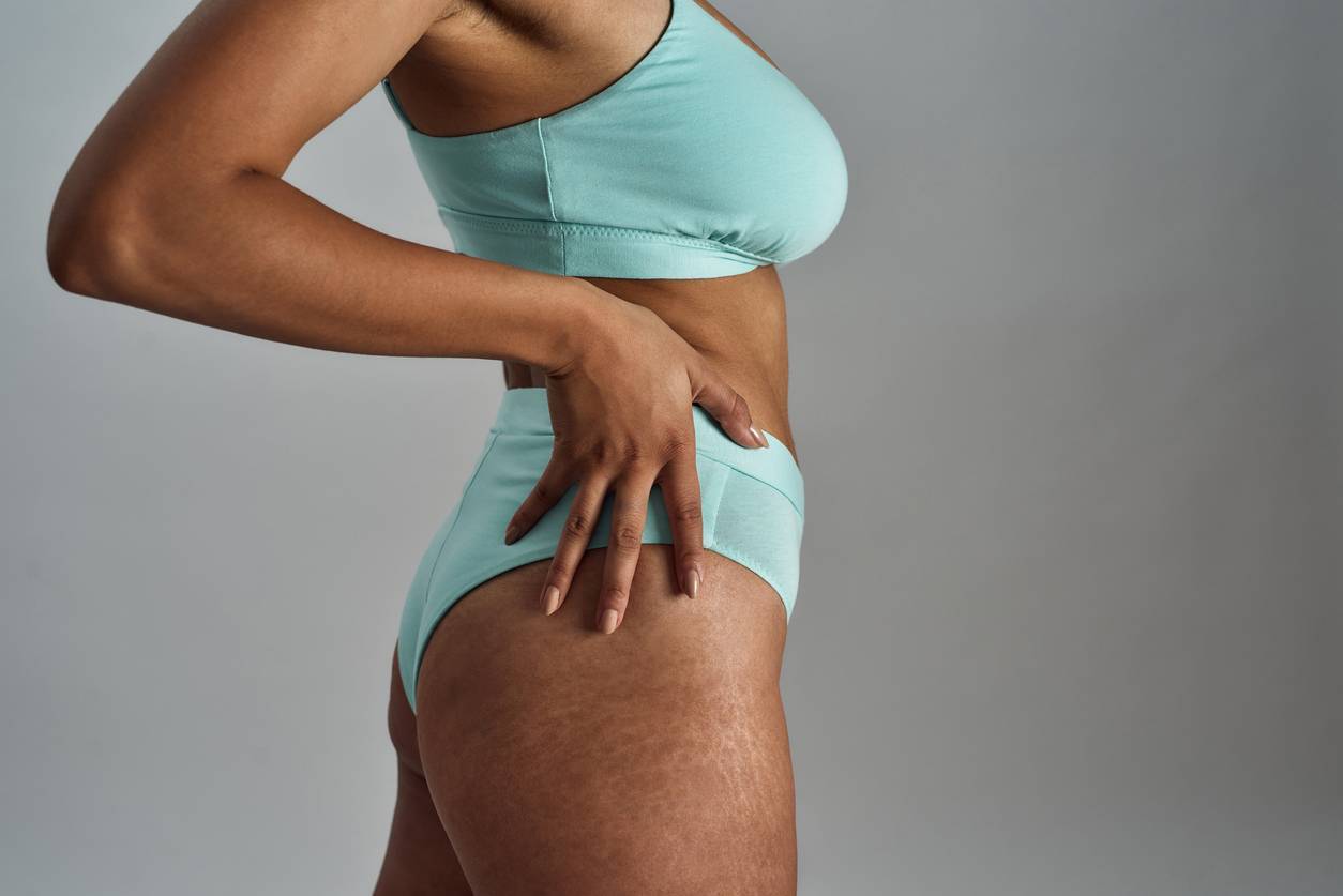 vergeture accouchement femme enceinte